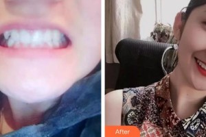 上海詮韓醫(yī)療美容醫(yī)院李健整形價格表附牙齒矯正案例展示