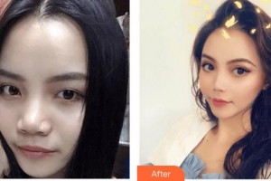 上海文峰醫(yī)療美容門診部楊希惠整形價格表附微針祛痘案例展示