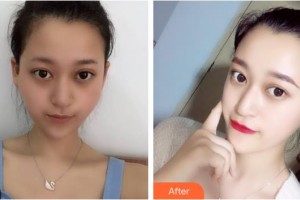 上海解放軍第四五五醫(yī)院激光整形科王曉陽整形價格表附顴骨降低案例展示