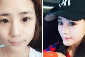 上海詮韓醫(yī)療美容醫(yī)院張杰整形價格表附小臉針瘦臉案例展示