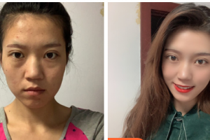 南京韓辰整形醫(yī)院李炯柱整形價格表附肋軟骨隆鼻案例展示