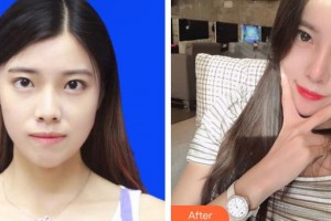 上海時光整形外科醫(yī)院陶琳整形價格表附肋軟骨隆鼻案例展示