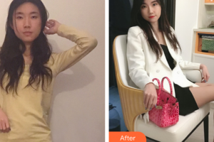 廣州遠(yuǎn)東美容醫(yī)院洪冰瑩主診醫(yī)師整形價格表附玻尿酸導(dǎo)入精華案例展示