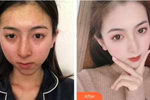 廣州博仕整形美容醫(yī)院王加凌整形價格表附健康素顏肌+牛奶酸案例展示