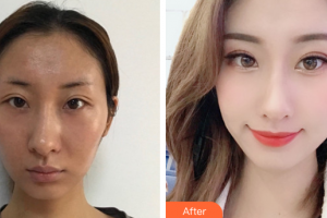 廣州中家醫(yī)家庭醫(yī)生醫(yī)學(xué)整形美容醫(yī)院劉永博整形價格表附顴骨內(nèi)推案例展示