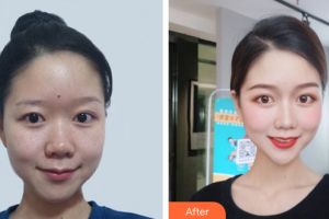 廣州韓妃醫(yī)學(xué)美容醫(yī)院孫華整形價格表附激光祛斑案例展示