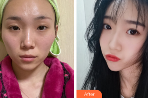 廣州中家醫(yī)家庭醫(yī)生醫(yī)學(xué)整形美容醫(yī)院龍曉枚整形價格表附顴骨內(nèi)推案例展示