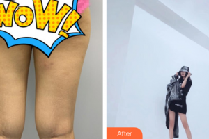 廣州海峽醫(yī)學(xué)整形美容醫(yī)院郭棟整形價格表附大腿吸脂案例展示