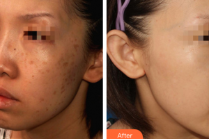 廣州美恩整形美容醫(yī)院許滿萍整形價格表附曬斑調(diào)節(jié)案例展示