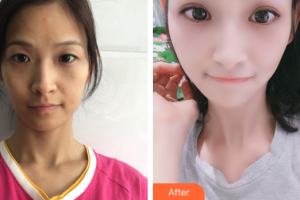 廣州中家醫(yī)家庭醫(yī)生醫(yī)學(xué)整形美容醫(yī)院鄭昱喆整形價格表附蘿莉美萌眼案例展示