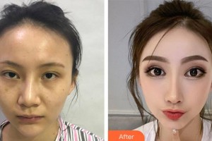 上海百達(dá)麗醫(yī)療美容醫(yī)院趙平萍整形價(jià)格表附鼻部手術(shù)整形案例展示