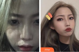 上海仁愛(ài)醫(yī)院整形美容科朱啟剛整形價(jià)格表附毛發(fā)種植案例展示