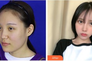 上海東方麗人美容醫(yī)療醫(yī)院吳永波整形價(jià)格表附鼻部手術(shù) 面部吸脂案例展示