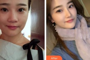 上海美立方整形醫(yī)院方爛碩整形價(jià)格表附隆鼻案例展示
