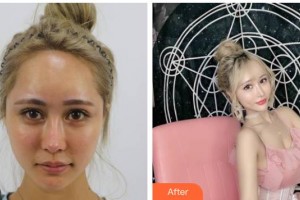 上海仁愛(ài)醫(yī)院整形美容科張少博整形價(jià)格表附酒窩案例展示