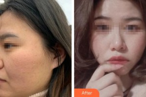 上海萬(wàn)眾醫(yī)院醫(yī)療美容科江超超整形價(jià)格表附點(diǎn)陣激光祛痘坑毛孔案例展示