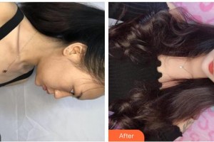 上海伊美爾港華醫(yī)療美容醫(yī)院陳媛整形價(jià)格表附果酸煥膚案例展示