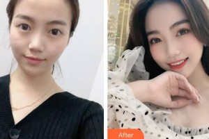 武警上?？傟?duì)醫(yī)院整形美容中心游萬(wàn)福整形價(jià)格表附無(wú)針?biāo)獍咐故?>
</a>
<h3 class=