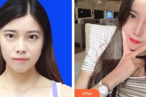 上海諾詩(shī)雅醫(yī)療美容醫(yī)院陳達(dá)整形價(jià)格表附肋軟骨隆鼻案例展示