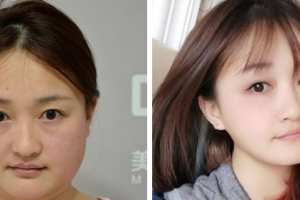 南京雨花城南口腔醫(yī)院羅敏整形價格表附種植牙案例展示