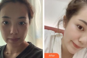 上海仁濟(jì)醫(yī)院整形外科金海蘭整形價(jià)格表附光子嫩膚案例展示