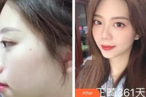 上海二醫(yī)大附屬第九人民醫(yī)院整形激光美容中心周?chē)?guó)瑜整形價(jià)格表附牙齒矯正案例展示