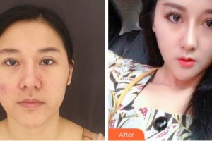 上海仁愛(ài)醫(yī)院整形美容科朱焱整形價(jià)格表附激光祛斑案例展示