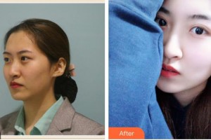 上海仁愛(ài)醫(yī)院整形美容科戴君來(lái)整形價(jià)格表附光子套餐案例展示