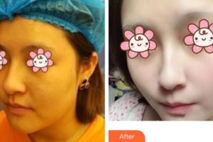 上海博愛(ài)醫(yī)院整形科傅文鳳整形價(jià)格表附激光祛斑案例展示