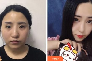 上海復(fù)旦大學(xué)附屬中山醫(yī)院整形外科楊震整形價(jià)格表附前茅面部吸脂案例案例展示