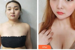 上海百達(dá)麗醫(yī)療美容醫(yī)院周珍艷整形價(jià)格表附豐胸案例展示