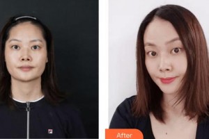 上?？祳W醫(yī)療美容醫(yī)院胡康容整形價格表附光子嫩膚案例展示