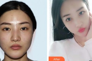 上海申德醫(yī)院醫(yī)療美容科金恩洙整形價格表附·顴骨內(nèi)推案例展示