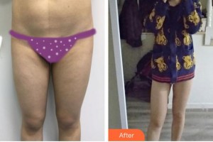 上海申德醫(yī)院醫(yī)療美容科劉啟整形價(jià)格表附腰腹加大腿吸脂案例展示