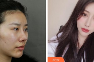 上海康馥麗醫(yī)療美容門診部魏艷玲整形價格表附顴骨+夾脂墊案例展示