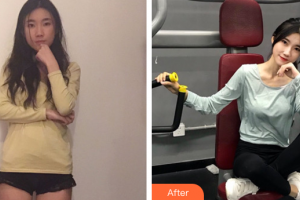 廣州番禺陽光整形美容醫(yī)院陳瑞雄整形價格表附玻尿酸導(dǎo)入案例展示