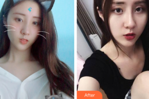 廣州伯明翰醫(yī)療整形美容醫(yī)院唐衛(wèi)華整形價格表附激光美膚激光祛斑案例展示