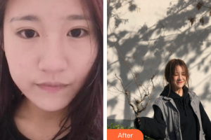 廣州醫(yī)學(xué)院第二附屬醫(yī)院整形美容中心肖和整形價格表附無針?biāo)獍咐故?>
</a>
<h3 class=