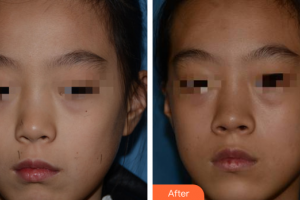 廣州美恩整形美容醫(yī)院朱思蓉整形價格表附激光點(diǎn)痣案例展示