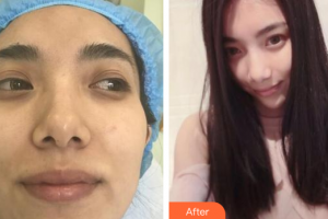 廣州美恩整形美容醫(yī)院王才仁整形價格表附小氣泡單次體驗(yàn)案例展示