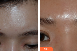 廣州美恩整形美容醫(yī)院汪晴整形價格表附激光美膚洗眉案例展示