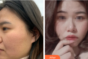 廣州美恩整形美容醫(yī)院賀芳秀整形價格表附祛痘坑案例展示