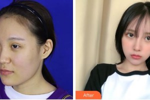 上海俏佳人整形外科門診部田苗苗整形價格表附鼻部手術(shù) 面部吸脂案例展示