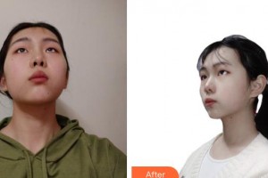 上海凱渥醫(yī)療美容門診部許心蕾整形價格表附光子嫩膚案例展示