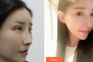 上海WA臻景醫(yī)療美容門診部KimSam整形價格表附雙眼皮修復(fù)案例展示