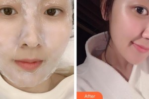 上海紐菲思醫(yī)療美容門診部孟玲玲整形價格表附點陣激光案例展示