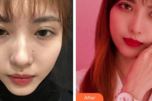 上海解放軍第八五醫(yī)院整形美容科羅瀾濤整形價格表附超激光美膚嫩膚多方面部案例展示