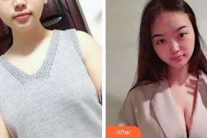 上海美立方整形醫(yī)院楊曉松整形價格表附濃縮豐胸真實案例展示