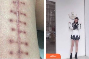 上海港華醫(yī)院浦東分院（悅?cè)葆t(yī)療美容診所）王美華整形價格表附微創(chuàng)疤痕修復(fù)案例展示