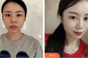 上海美爾雅醫(yī)療美容醫(yī)院李知垠整形價格表附美眼部手術(shù)案例展示